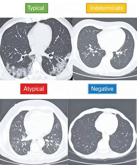 The Impact of Chest Computed Tomography in a COVID-19 …