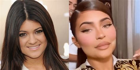 The Kardashians: Kylie Jenner Plastic Surgery Timeline …