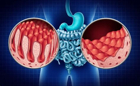 The Liver in Celiac Disease