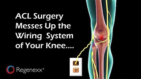 The Long-Term Effects of ACL Reconstruction Surgery - Regenexx