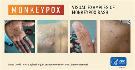 The Monkeypox Scare: How to Protect Yourself and Your Family