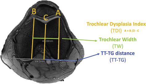 The Normal Value of Tibial Tubercle Trochlear Groove Distance in ...