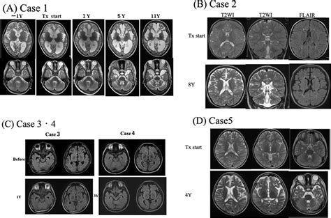 The Palliative Use of Intrathecal Baclofen in Niemann-Pick …