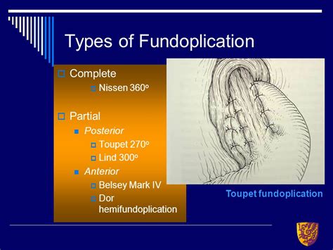 The Posterior Partial Toupet Hemifundoplication Request PDF