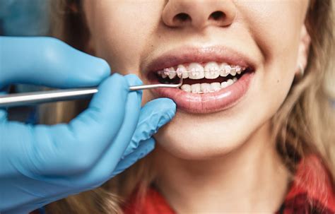 The Process of Getting Braces - Orthodontics Limited