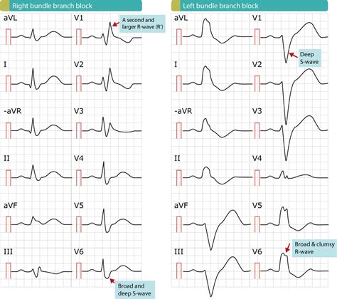 The RSR′ complex not related to right bundle branch block