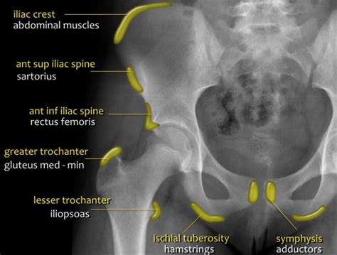 The Radiology Assistant : Hip pathology in Children