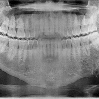 The Rare Radiographic Sunburst Appearance of Odontogenic