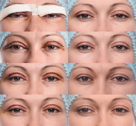 The Recovery Process of Blepharoplasty: What to Expect After …