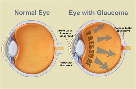 The Relationship Between Glaucoma and …