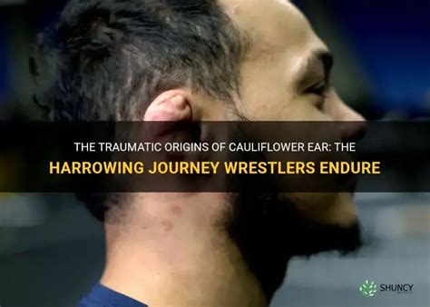 The Traumatic Origins Of Cauliflower Ear: The Harrowing ...