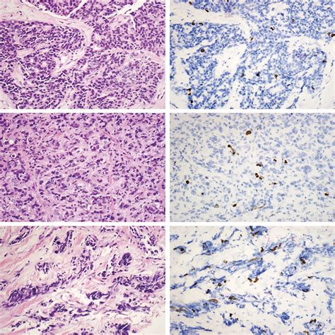 The Utility of Phosphohistone H3 in Breast Cancer Grading