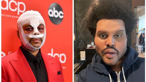 The Weeknd shocks with plastic surgery in