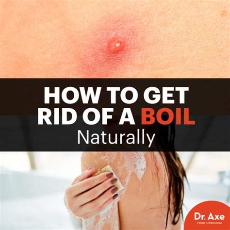 The boil. A boil is a red, painful, lump on the skin that develops at the site of an infected hair follicle. They are also called furuncles. A hair follicle is a small cavity in the skin from which a hair grows. Boils most commonly develop on areas of skin where there is a combination of hair, sweat and friction, such as the neck, face or thighs. 