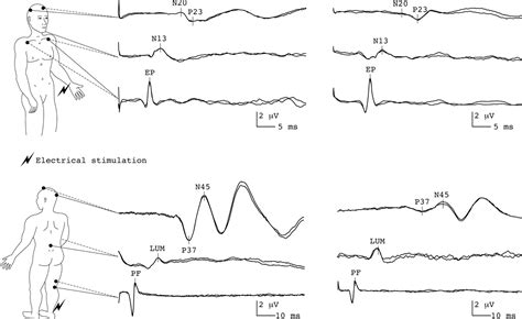 The clinical role of evoked potentials Journal of …