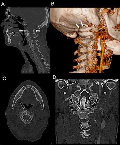 The craniovertebral junction, between osseous variants and