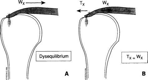 The deadman theory of suture anchors: observations along a …