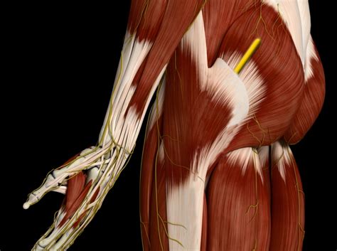 The direct superior approach in total hip arthroplasty - PubMed