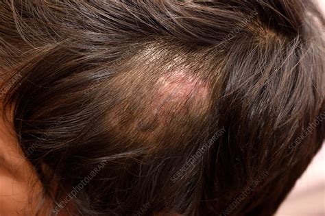 The first case report of kerion-type scalp mycosis caused by