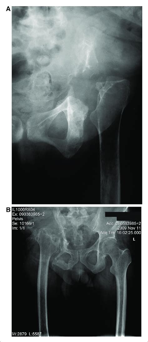 The hemipelvis: an unusual site of osteonecrosis. A report of