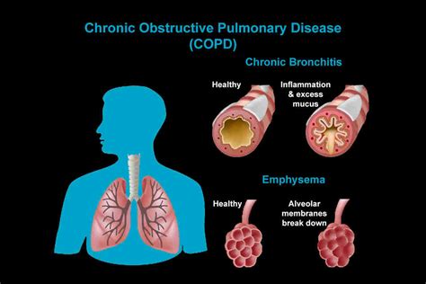 The history of COPD - PubMed