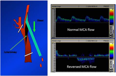 The history of proximal carotid protection and flow reversal to …