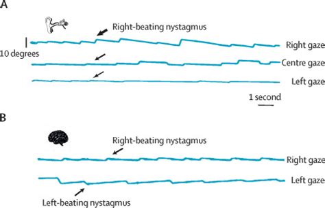 The hyperacute vestibular syndrome: ear or brain?