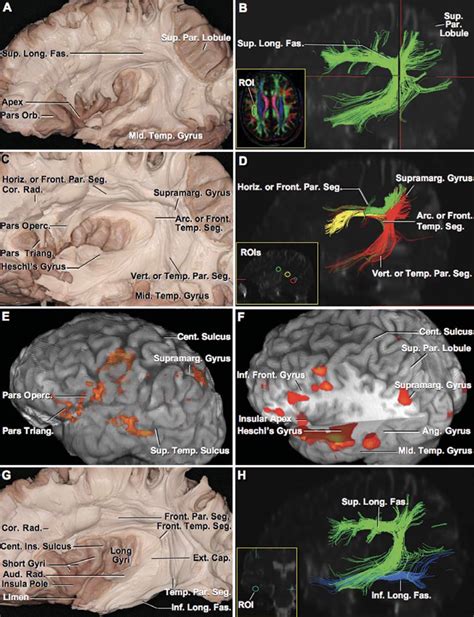 The inferior longitudinal fasciculus: anatomy, function and