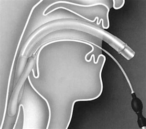 The laryngeal mask airway: potential applications in neonates