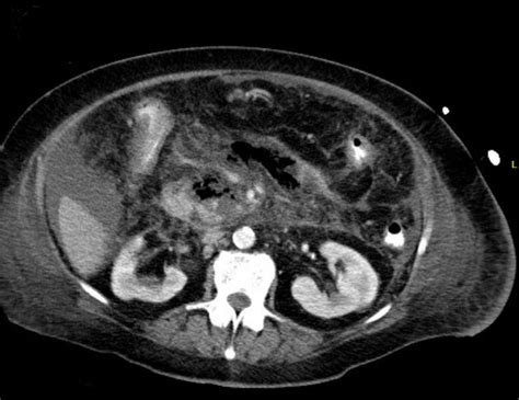 The management of acute pancreatitis and how to avoid them