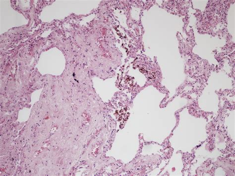 The pathology of asbestosis - Diagnostic Histopathology