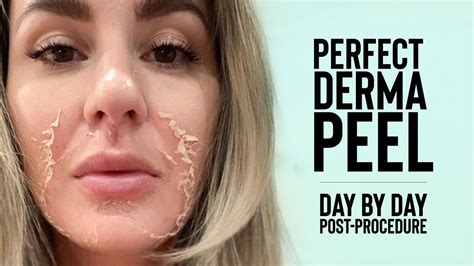 The perfect derma peel. What Is The Perfect Derma Peel? The Perfect Derma Peel takes around 5-15 minutes and involves the application of a chemical that penetrates 2-3 layers of your skin. Benefits of The Perfect Derma Peel The Perfect Derma Peel can lighten your skin and reveal healthier skin tissue. It can also reduce the appearance of … 