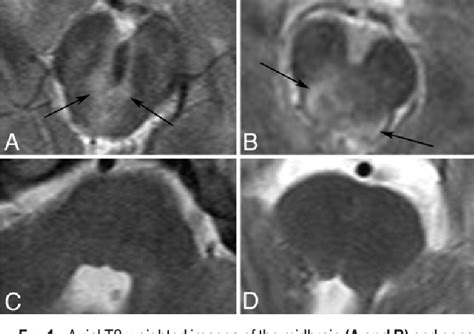 The prognostic significance of traumatic brainstem injury