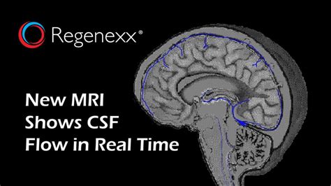 The recent pandemic has however, prevented adequate enrolment, alongside client hesitance to perform anesthesia for MRI and CSF collection