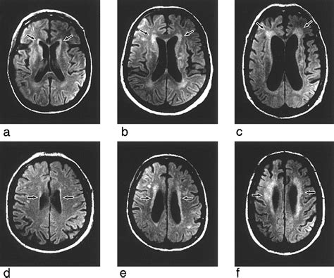 The relationship of a white matter hyperintensities rating scale …