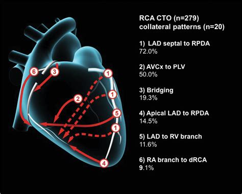 The role of coronary collaterals in chronic total occlusions