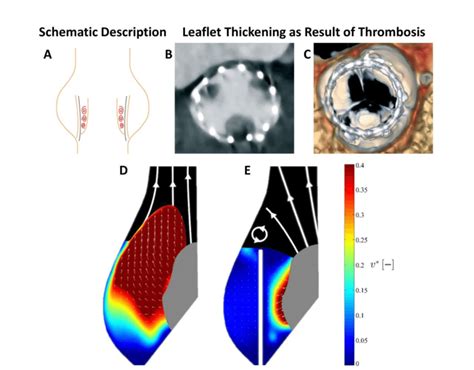 The role of flow stasis in transcatheter aortic valve leaflet ...