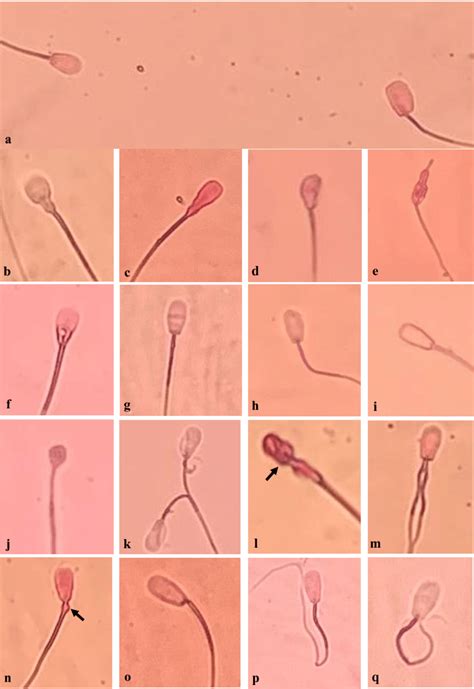 The significance of pyriform (pear-shaped) sperm heads in sperm ...