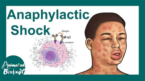 The signs and symptoms of anaphylactic shock – SheKnows