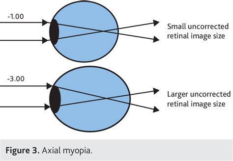 The tolerance of anisometropia - PubMed