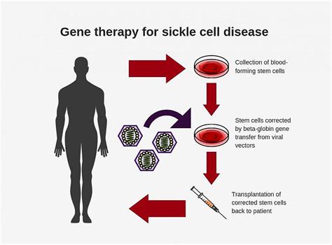 The world’s first gene therapy for sickle cell disease has been approved in Britain
