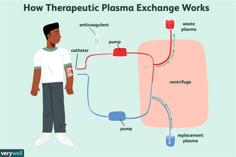 Therapeutic Plasma Exchange in Patients with Neurologic.