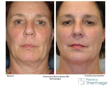 Thermage FLX Sydney Skin Tightening Sydney Dr Buddy Beaini