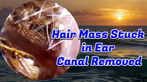 Thick hair mass stuck in ear canal removed - YouTube