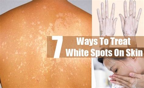 This Is How to Treat White Spots on Skin The Healthy