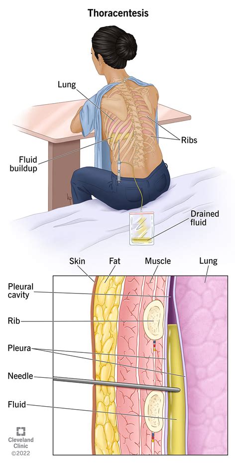 Thoracentesis: Medical Terminology - 265 Words Bartleby