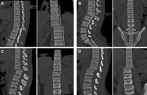 Thoracic Spine Fractures and Dislocations Treatment & Management - Medscape