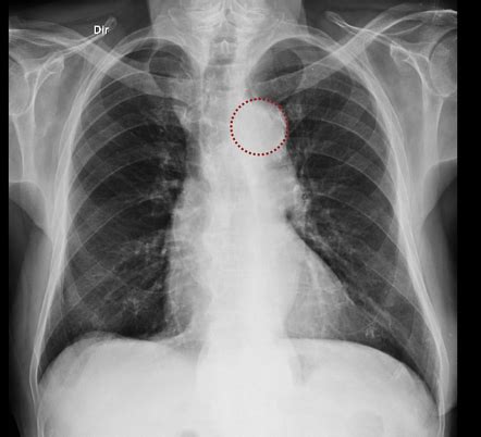 Thoracic aortic dilatation (differential) - Radiopaedia