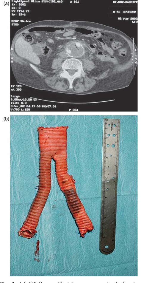 Thoracofemoral Bypass Using Spliced Femoral Vein with Removal …