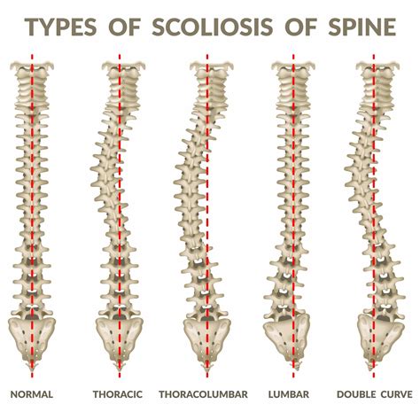 Thoracolumbar Scoliosis: Causes, Symptoms, Treatment, …